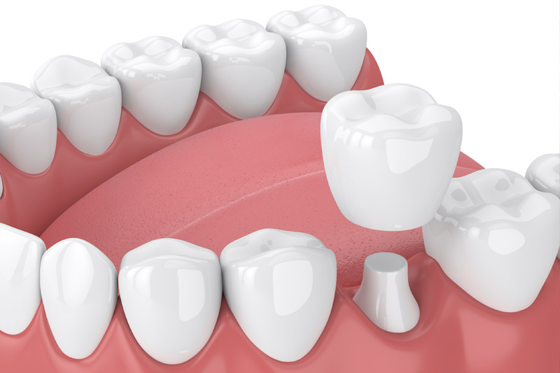 Dental Crowns in Culver City