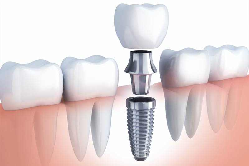 Implants Dentist in Culver City