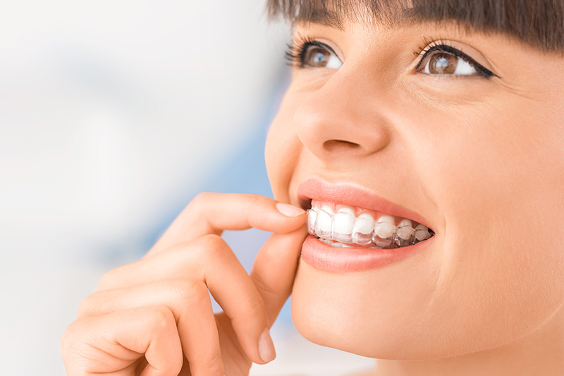 Invisalign in Culver City