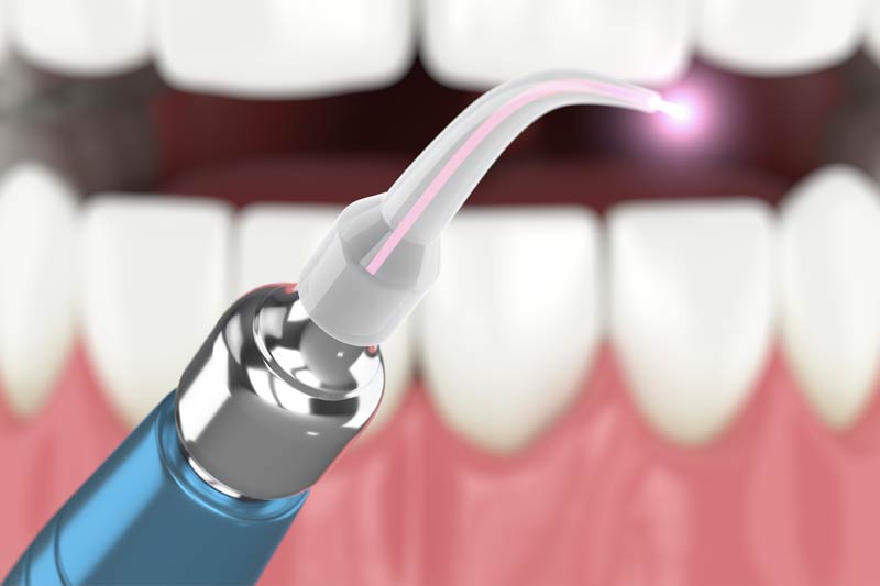 Laser Dentistry in Culver City