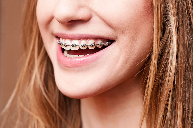 Orthodontics in Culver City