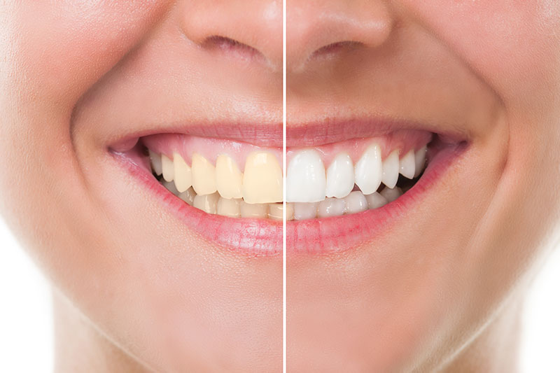 Teeth Whitening in Culver City