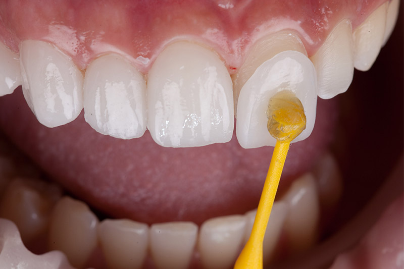 Bimbli Smiles Dental Special Offer
